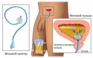Чем смазывать урологические катетеры