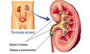 Камень в нижней трети мочеточника как вывести — Почки