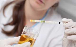 Белок в моче у ребенка – норма. Повышенный белок в моче у ребенка – причины, лечение