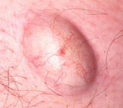 Что это если за ухом опухоль