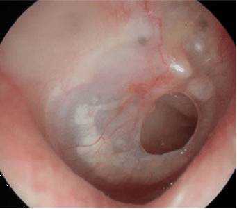 перфорации барабанной перепонки