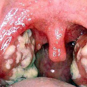 Как лечить обострение хронического тонзиллита