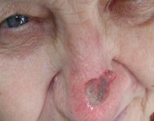 базалиома носа лечение