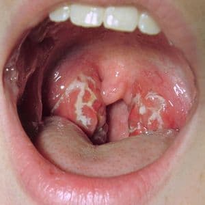 Что делать, если в горле шишки