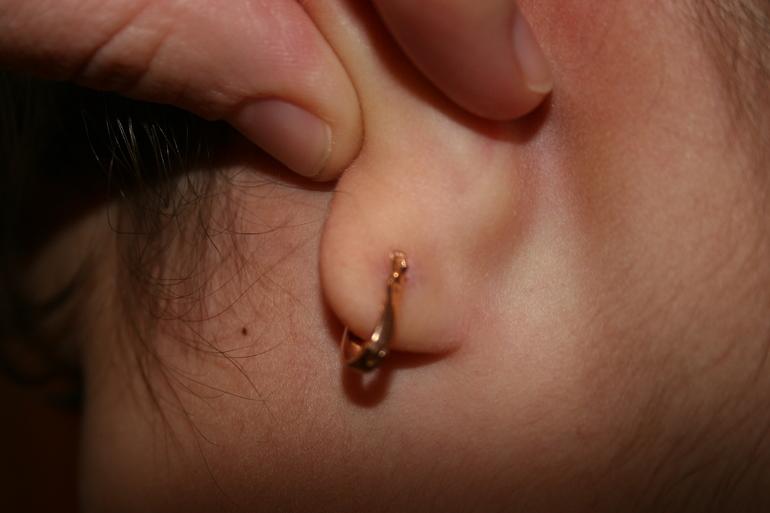 после прокола уха образовалась шишка