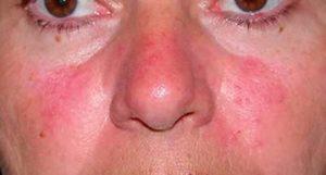 Что делать когда нос покраснел или посинел?