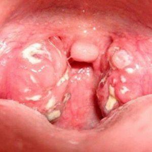 Как лечить обострение хронического тонзиллита