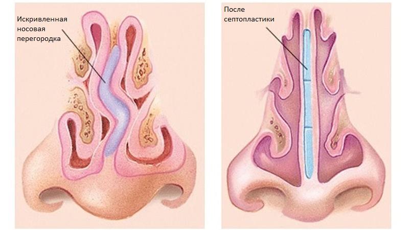 может ли быть фронтит без температуры