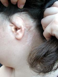 сломан хрящ на ухе симптомы