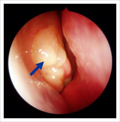 -гипертрофия лимфоидной ткани свода глотки что это