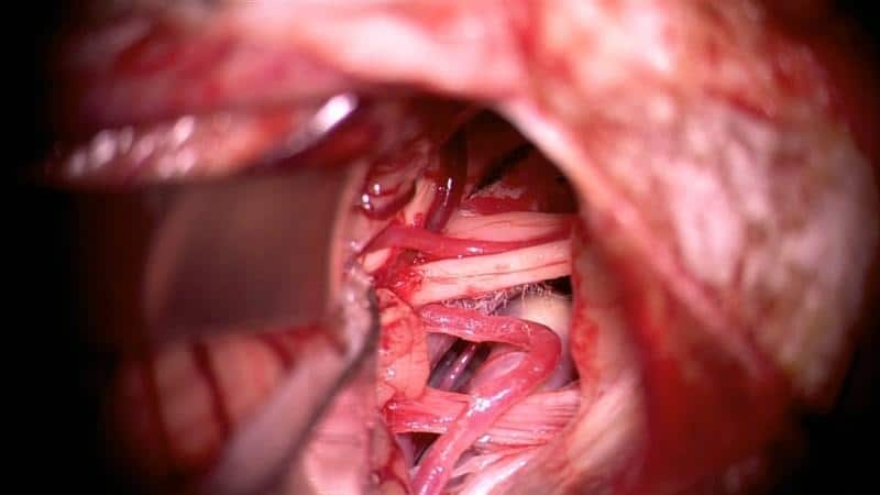 как лечить спайки в носу после операции