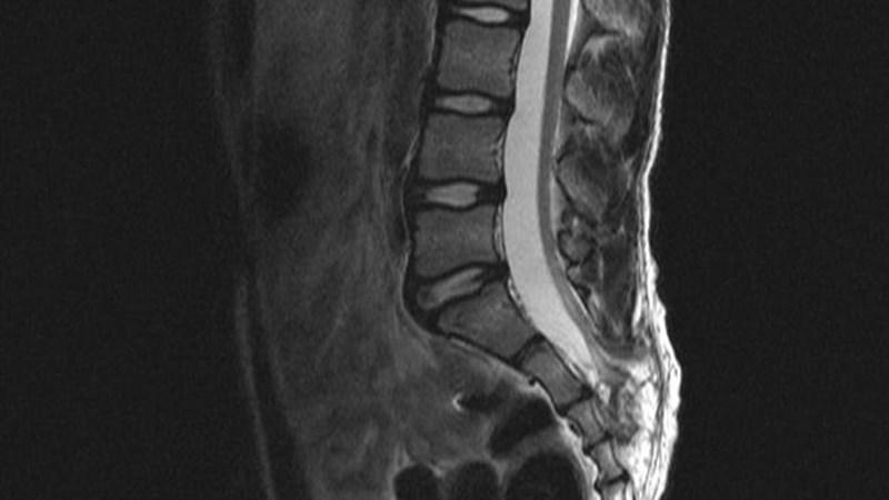 синусопатия головного мозга
