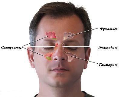 Как распознать и вылечить синусит?