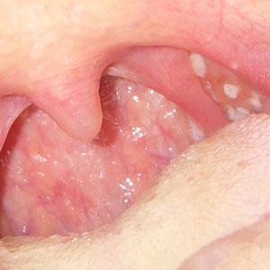 Какие ингаляции можно делать при фарингите