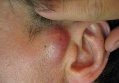 -киста за ухом фото