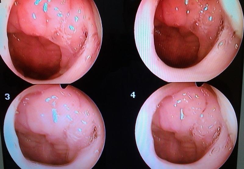 Что такое аденоиды в носу