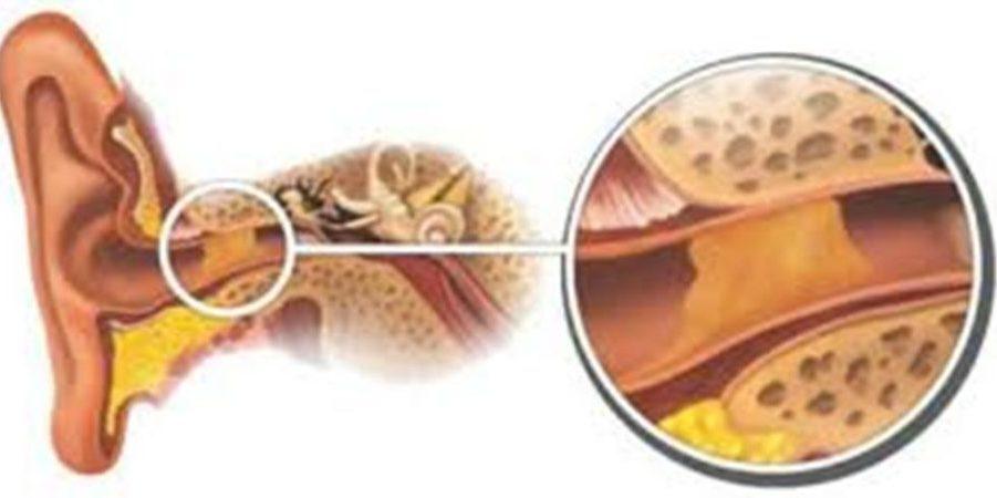 какие бывают отиты у взрослых