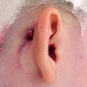 Что такое отомастоидит и как его лечат