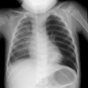 Что такое пневмоторакс