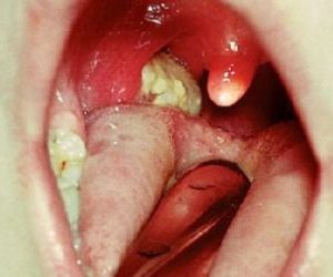 Что за болезнь дифтерия и как её лечить