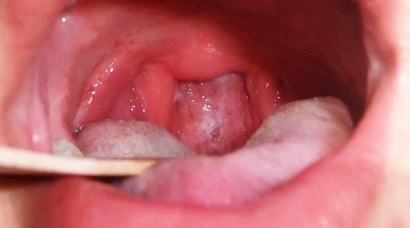 Что за болезнь дифтерия и как её лечить