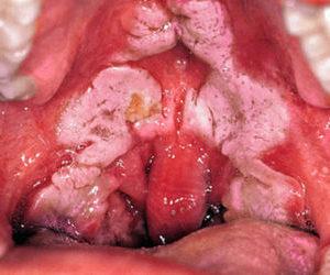 Что за болезнь дифтерия и как её лечить