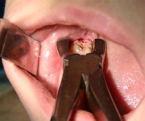 Что делать, если из-за зуба болит горло