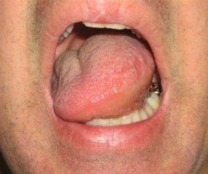 Что делать, если из-за зуба болит горло