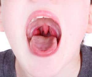 Что делать, если воспалились гланды