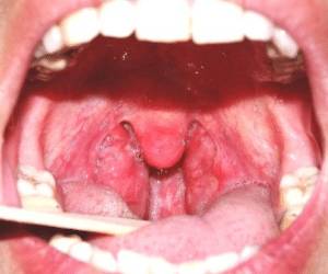 Что такое небные миндалины