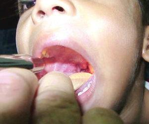 Что такое небные миндалины