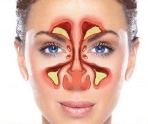 Что такое сфеноидит