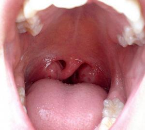 Что такое стеноз гортани и как его лечить