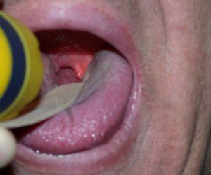 Как лечить апноэ сна