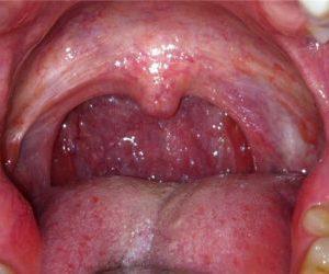 Как лечить атрофический фарингит