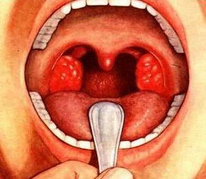 Как лечить бактериальный тонзиллит
