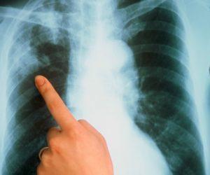 Как лечить белую мокроту при кашле?