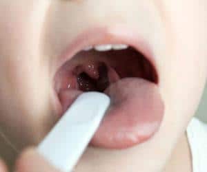 Как лечить флегмонозную ангину