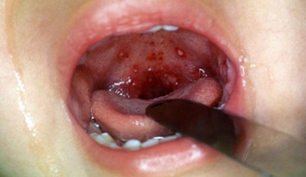 Как лечить флегмонозную ангину