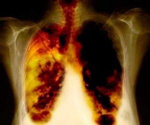 Как лечить гнойный плеврит