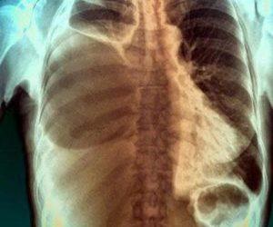 Как лечить экссудативный плеврит