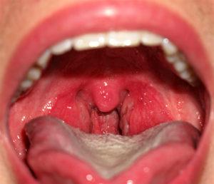 Как лечить катаральный ларингит