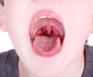 Как лечить компенсированную форму хронического тонзиллита