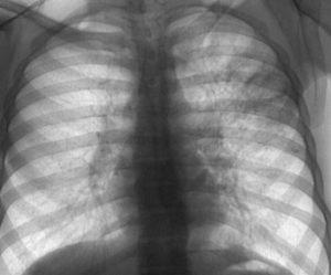 Как лечить осумкованный плеврит