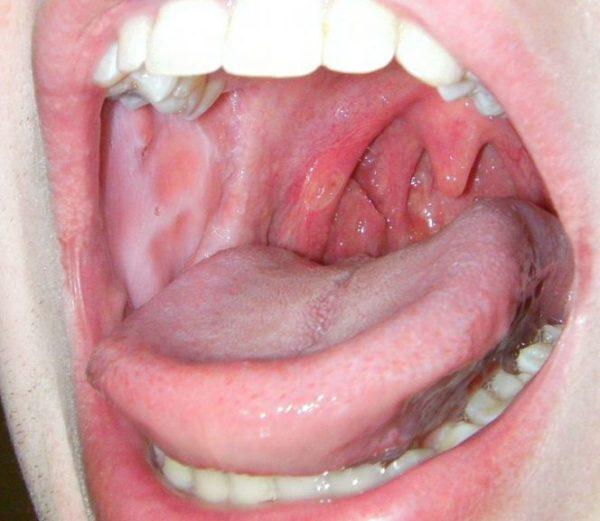 Как лечить ожог слизистой горла