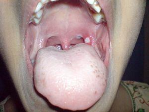Как лечить ожог слизистой горла