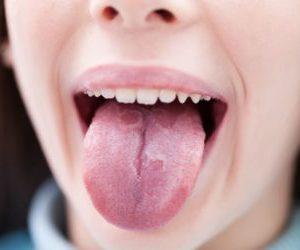 Как лечить ожог слизистой горла