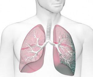 Как лечить пневмосклероз
