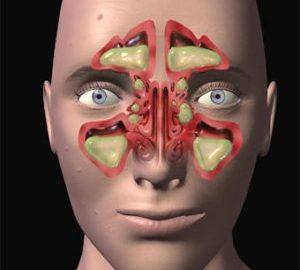 Как лечить постназальный синдром