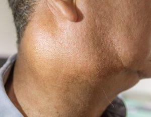 Как лечить сиаладенит